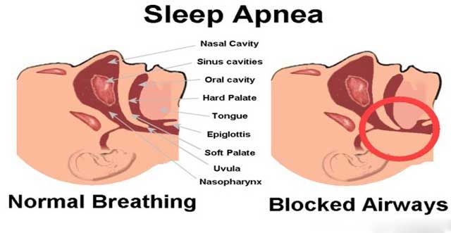 sleep apnea treatment kerala